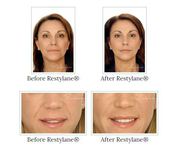 Change the appearance of your nose with Rhinoplasty in Los Angeles