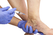 Sclerotherapy San Diego - Vein Clinic San Diego