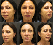 Facelift surgery gives a new look of your face